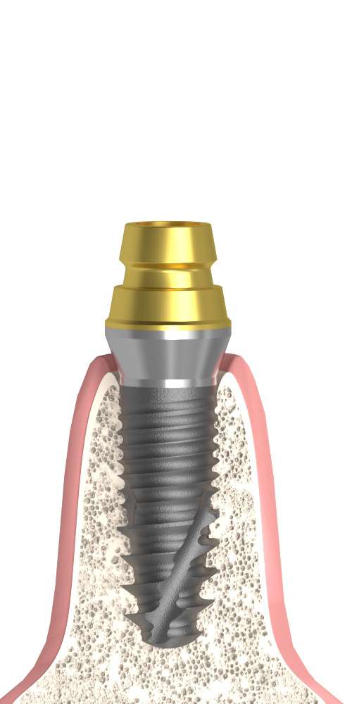 DENTUM, Titán bázis, multi-unit szintű, pozicionált