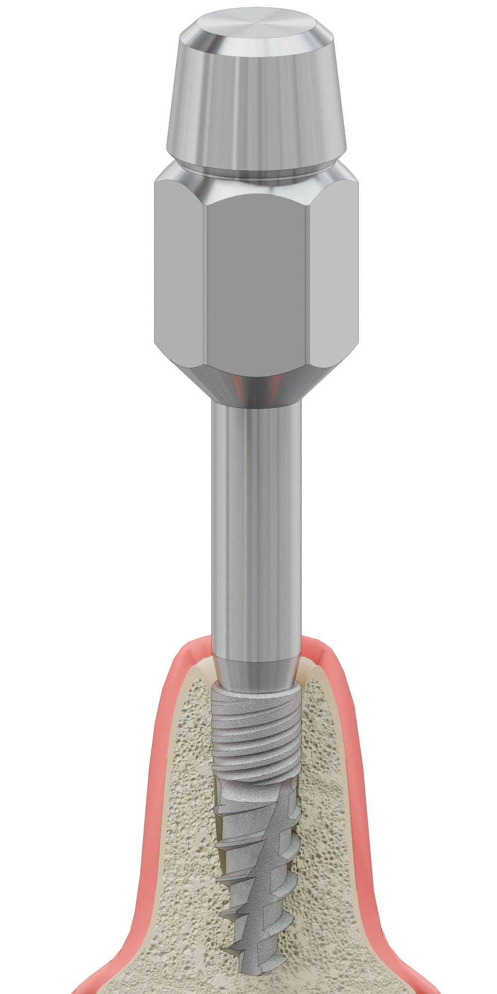 BIONIKA DENTUM, Implantátum behajtó, kézi, lamellás, Bionika