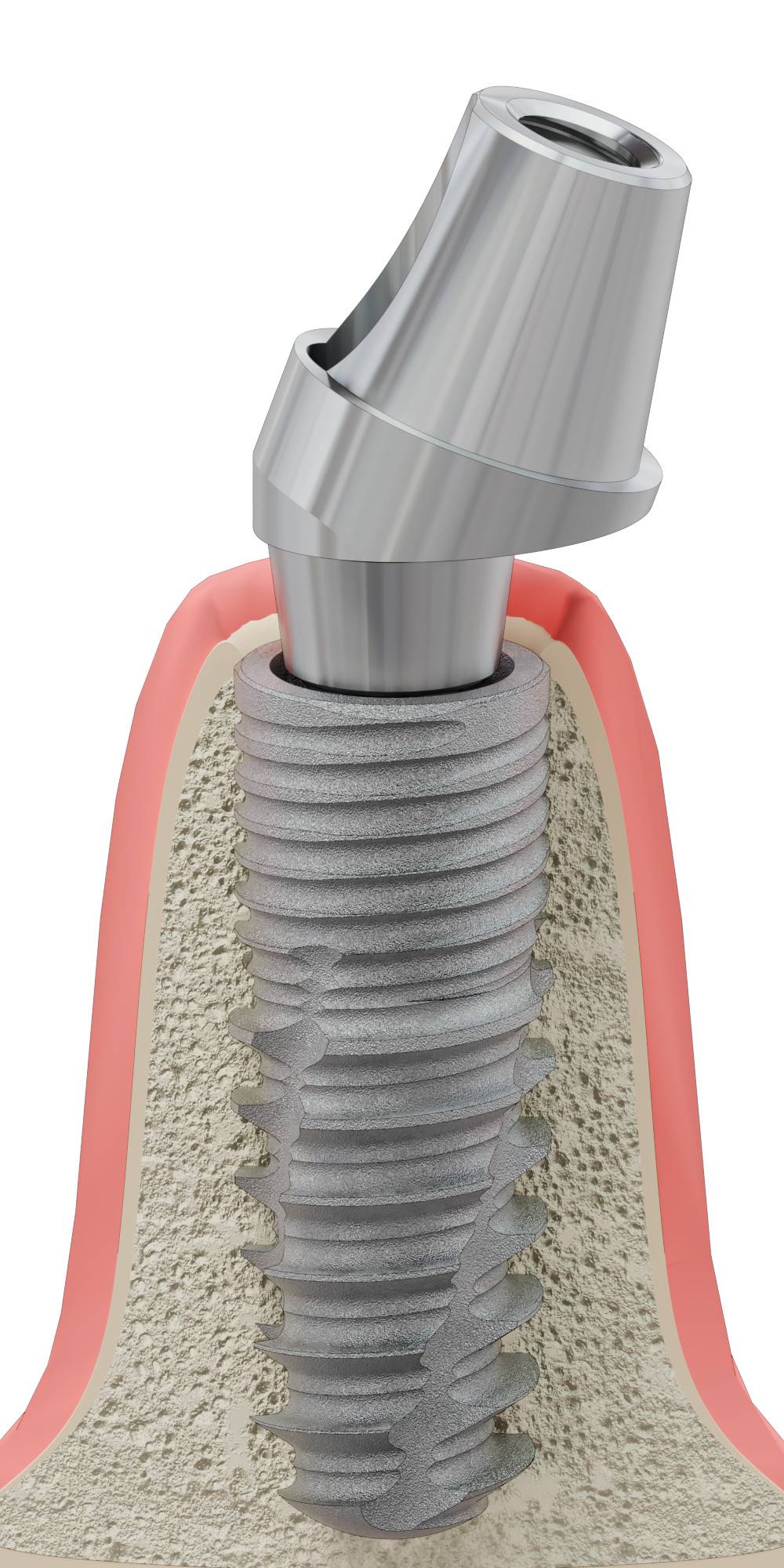 BIOSS, Multi-unit SR fej, ferde, pozicionált, A-típus