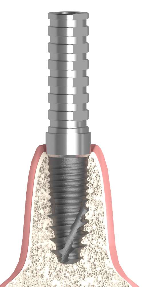 Neoss® (NO) UNIFORM Ideiglenes fej implant szintű