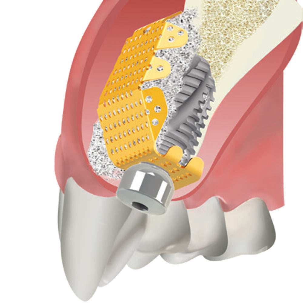 Speciális sík lemez, szárnyas