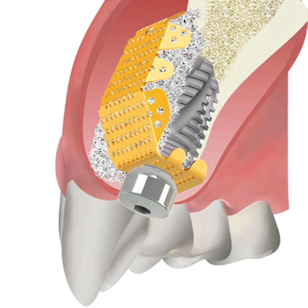 Speciális sík lemez, furatos