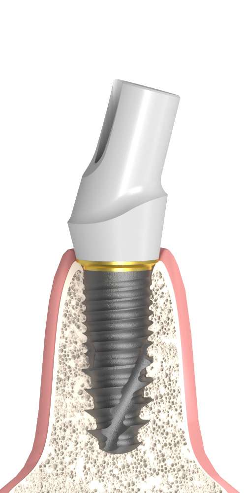 ANKYLOS® C (CA) Compatible Cirkon fej titán alappal ferde, pozicionált, B-típus