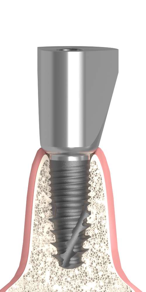 MIS® C1® (C1) Compatible Delta fej, pozicionált, B-típus