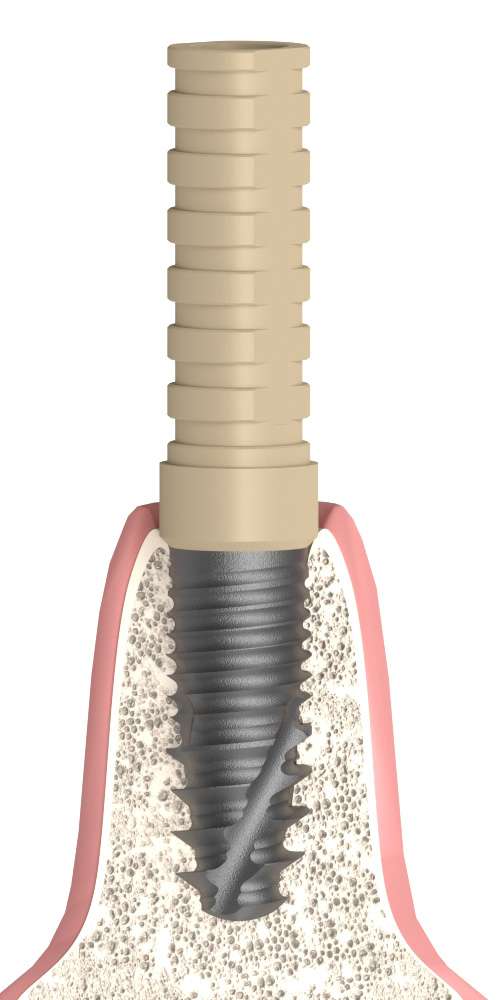 BIONIKA Bonelit Ideiglenes fej implant szintű PEEK