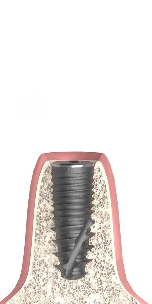 DENTOSS, Implantátum