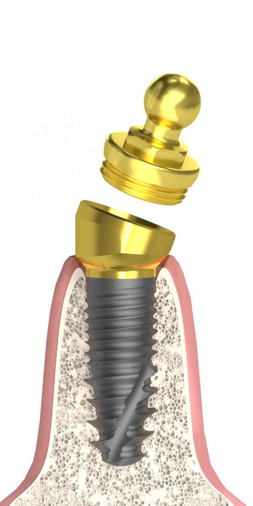 Implant Direct® Replant® (RE) Compatible Multi-Compact csésze (MC fej) ferde, B-típus M1.6 Gömbfejjel