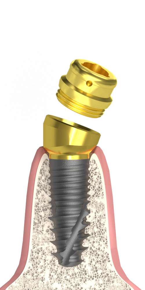 Implant Direct® InterActive® (ID) Compatible Multi-Compact csésze (MC fej) ferde, B-típus M1.6 Lokátorfejjel