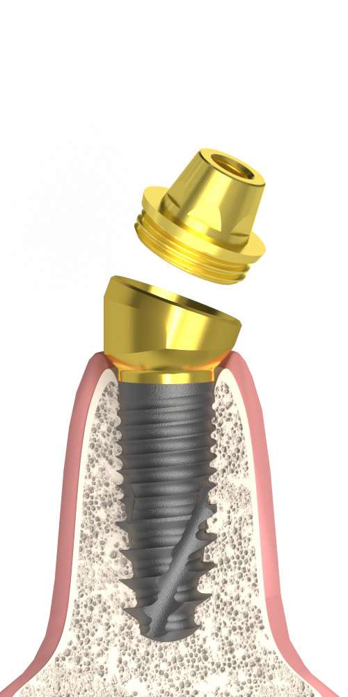 Implant Direct® Replant® (RE) Compatible Multi-Compact csésze (MC fej) ferde, B-típus M1.6 Multi-unit kúppal