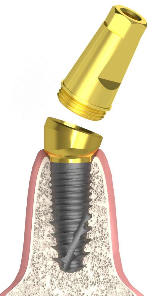 Implant Direct® Replant® (RE) Compatible Multi-Compact csésze (MC fej) ferde, B-típus M1.6 csiszolható fejkúppal