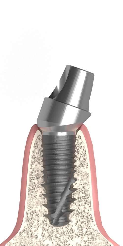 Implant Direct® InterActive® (ID) Compatible Multi-unit SR fej, ferde, pozicionált, B-típus