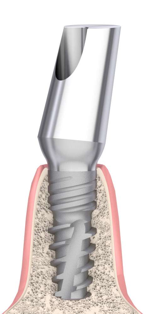 Neodent® GM® (ND)  Compatible Univerzális fej ferde, B-típus