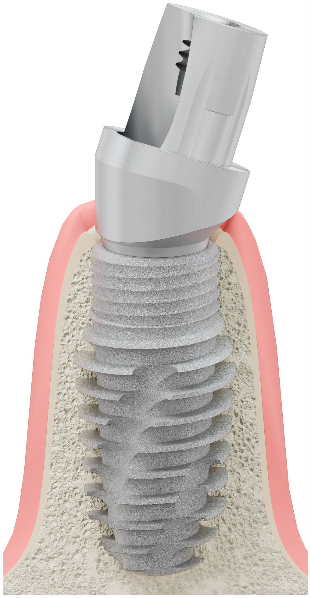 BIONIKA TH, Titán bázis, ferde, pozicionált, B-típus