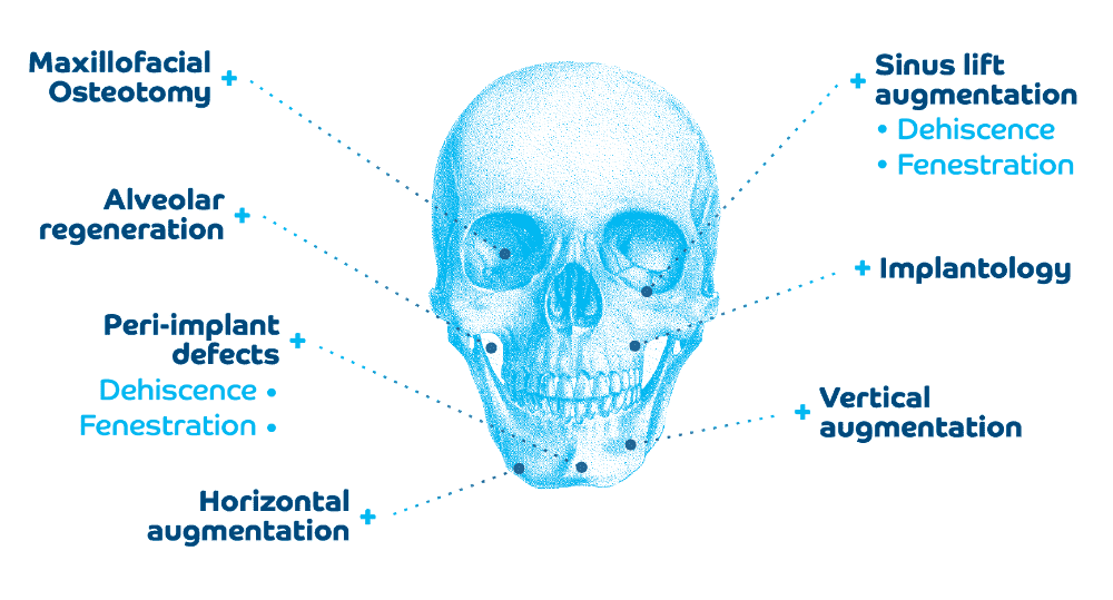 Medbone® Adbone BCP Henger