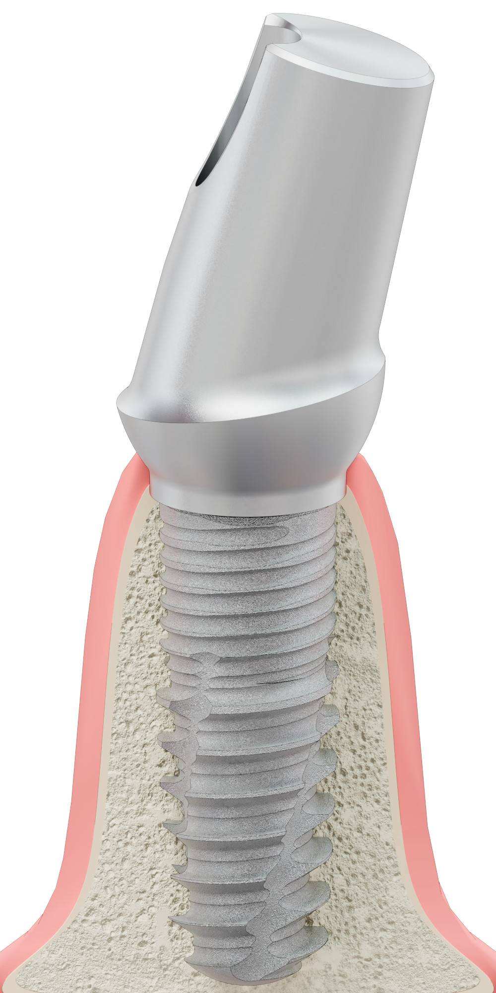 HICON, Anatómiai fej, ferde, 15°, pozicionált, B-típus