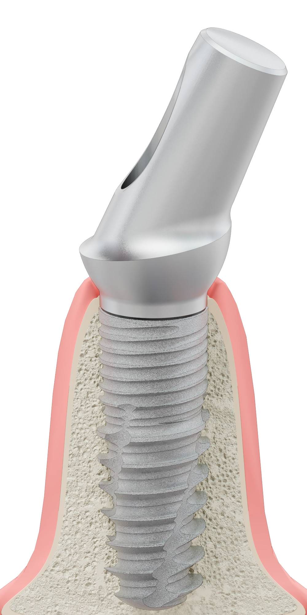 ACTIVAL, Anatómiai fej, ferde, 25°, pozicionált, B-típus