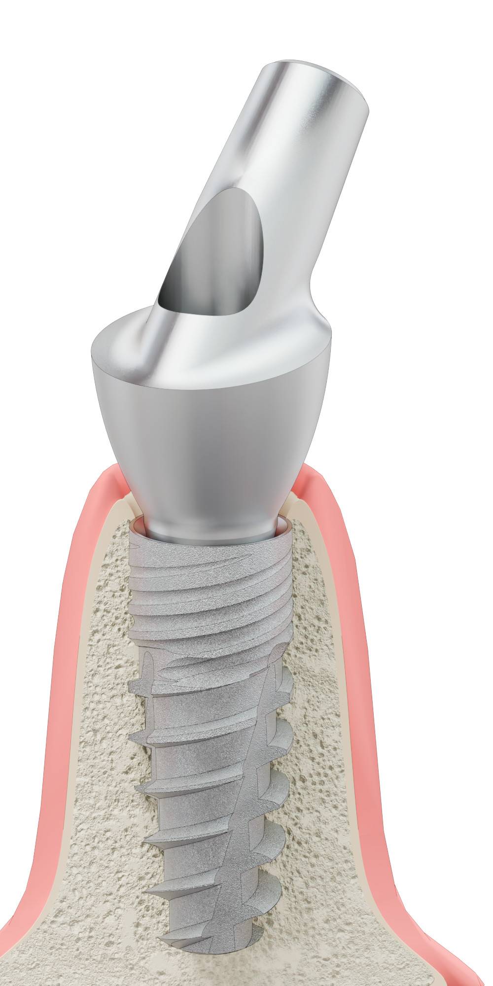 DENTUM, Anatómiai fej, ferde, 45°, pozicionált, A-típus