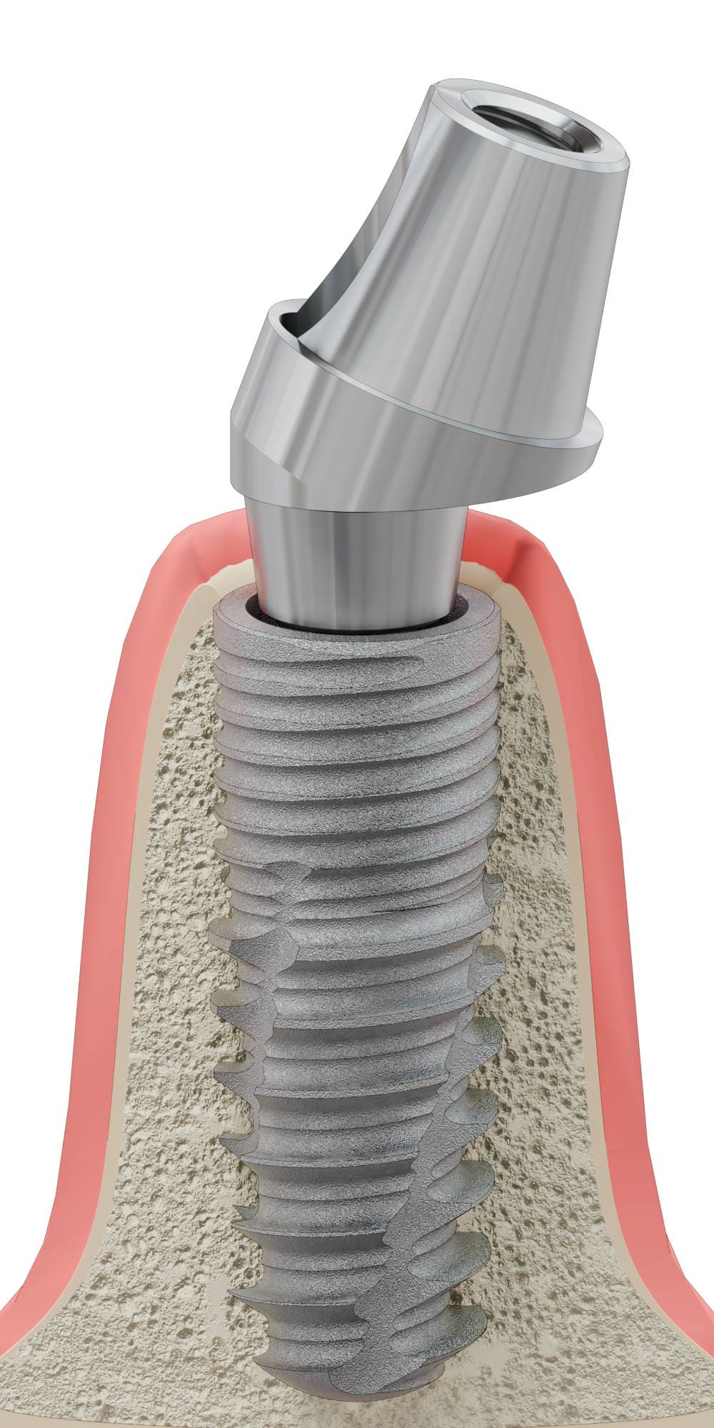 DENTUM, Multi-unit SR fej, ferde, pozicionált, A-típus