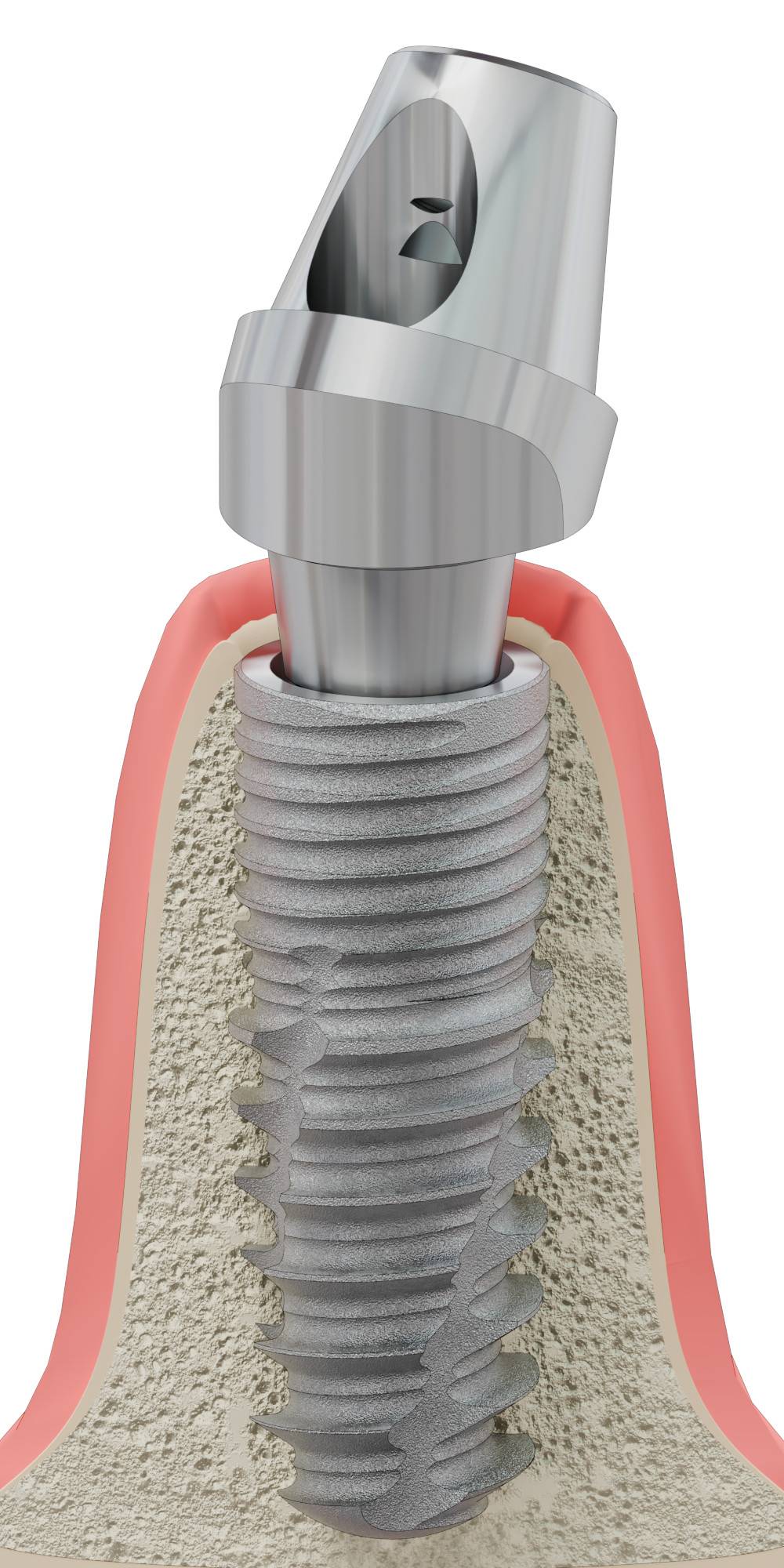 DENTUM, Multi-unit SR fej, ferde, pozicionált, B-típus