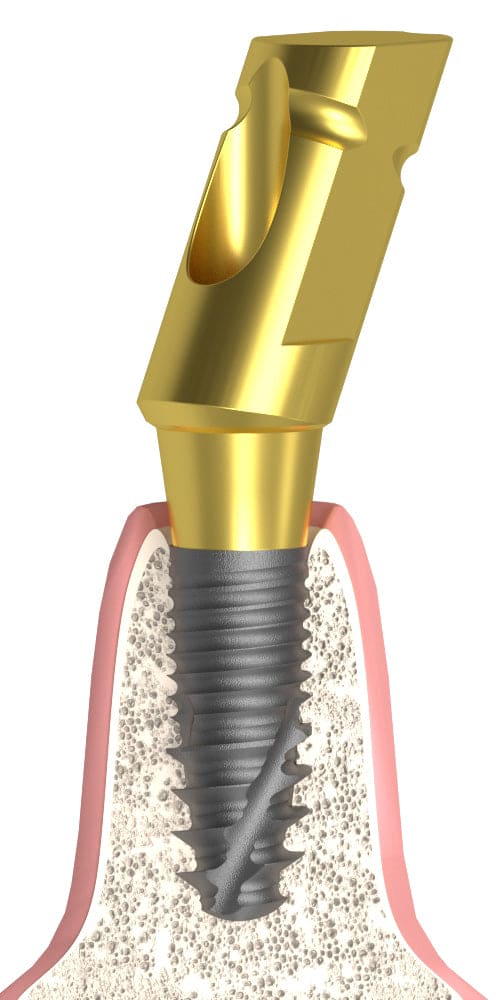 Oralplant® (OR) Compatible Mintavételi fej zárt kanálhoz ferde