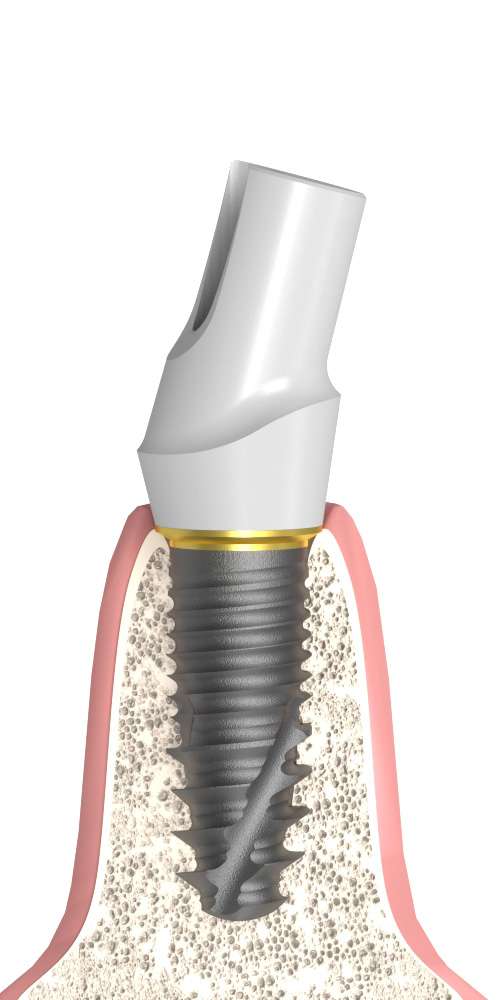 Oralplant® (OR) Compatible Cirkon fej titán alappal ferde, nem pozicionált