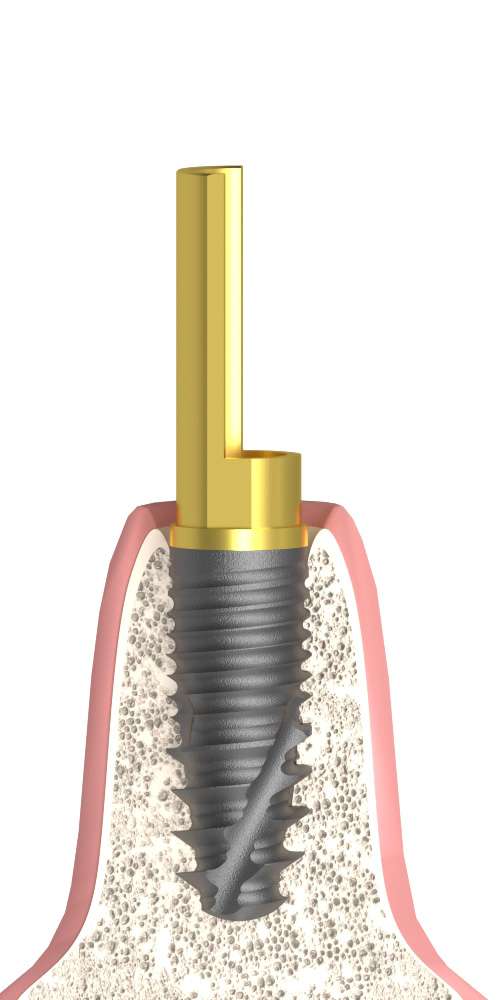 Dentium® Superline (DM) Compatible Csőfej PCT lépcsős implant szintű, pozicionált