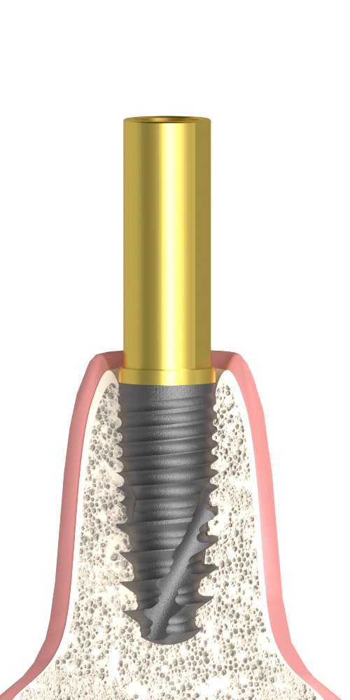 Bioplant Csőfej implant szintű, pozicionált