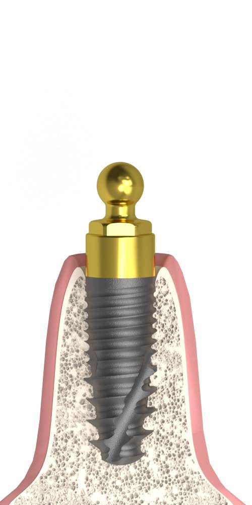 Implant Direct® Replant® (RE) Compatible Gömbfej OC