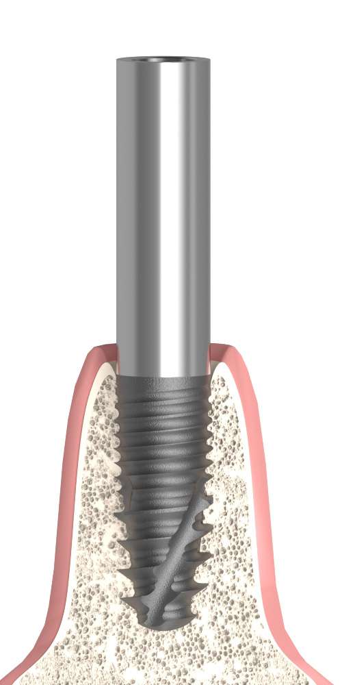 Implant Direct® InterActive® (ID) Compatible Hengeres fej