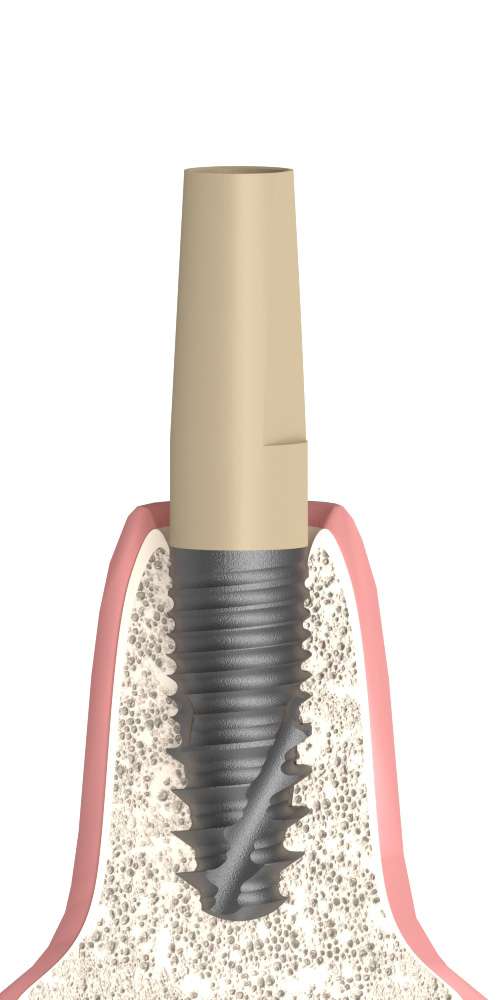 Oralplant® (OR) Compatible Keskeny fej egyenes PEEK