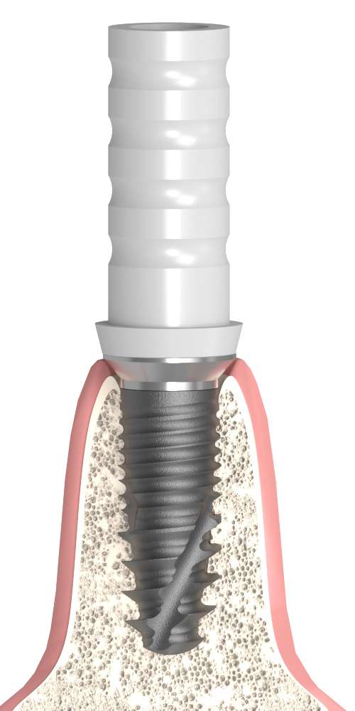 Oralplant® (OR) Compatible Kiégethető műanyag fej Co-Cr alappal implant szintű, nem pozicionált