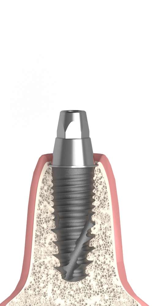 Implant Direct® Replant® (RE) Compatible Multi-unit SR fej átmenőcsavaros kiégethető műanyag fejrésszel