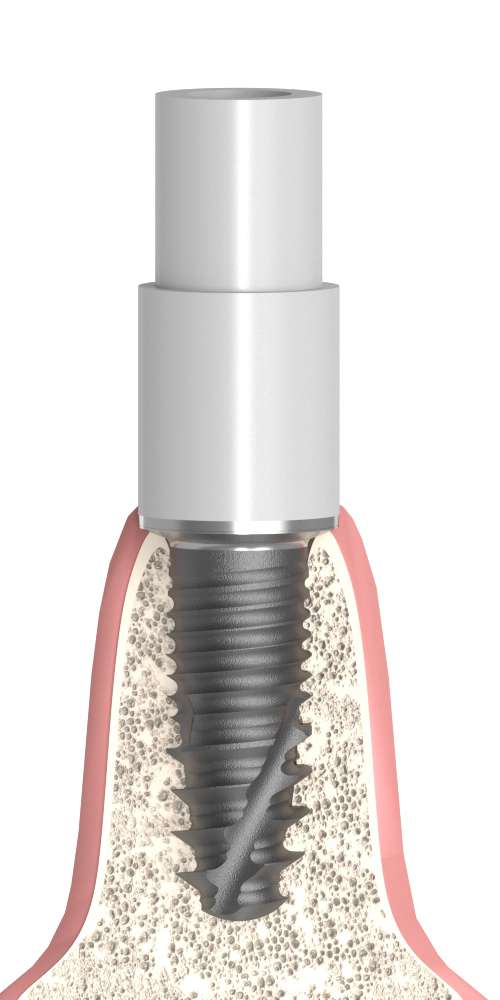 Oralplant® (OR) Compatible Multi-unit SR fej műanyag sapka Co-Cr alappal, pozicionált