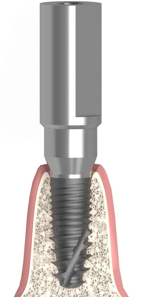 Implant Direct® Replant® (RE) Compatible Scanbody átmenőcsavaros Multi-unit szintű, pozicionált