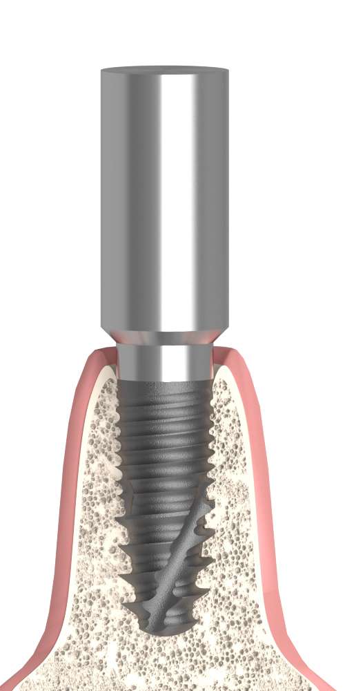 Implant Direct® Replant® (RE) Compatible Scanbody becsavarható, nem pozicionált