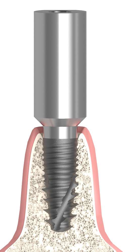 Implant Direct® Replant® (RE) Compatible Scanbody fej átmenőcsavaros, pozicionált