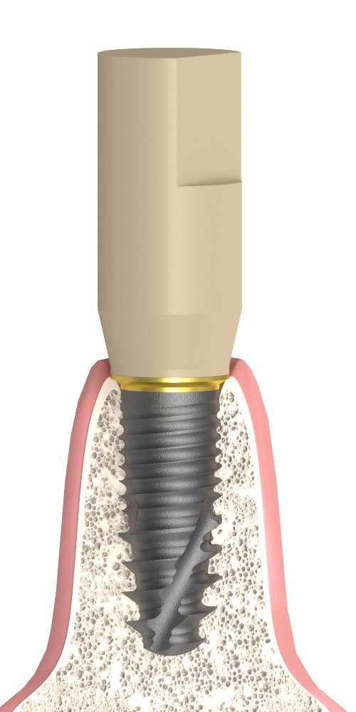 Implant Direct® Replant® (RE) Compatible Titán bázis Scan fej PCT lépcsős PEEK